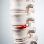 Hernia herkennen en behandelen - Fysiopark Boshoven